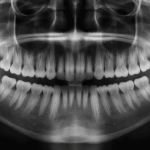 Wat kunnen tandartsen zien op r&ouml;ntgenfoto&rsquo;s?